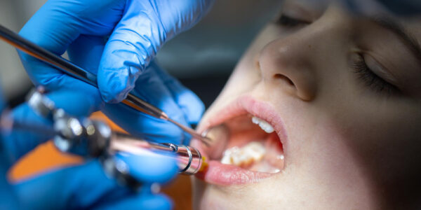 Stłoczenie zębów – co to jest i jak je rozpoznać?