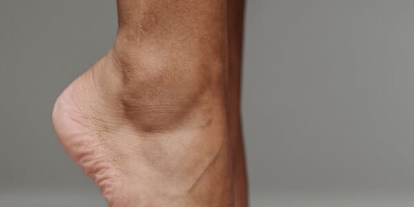 Orteza na opadającą stopę - dla kogo jest przeznaczona?